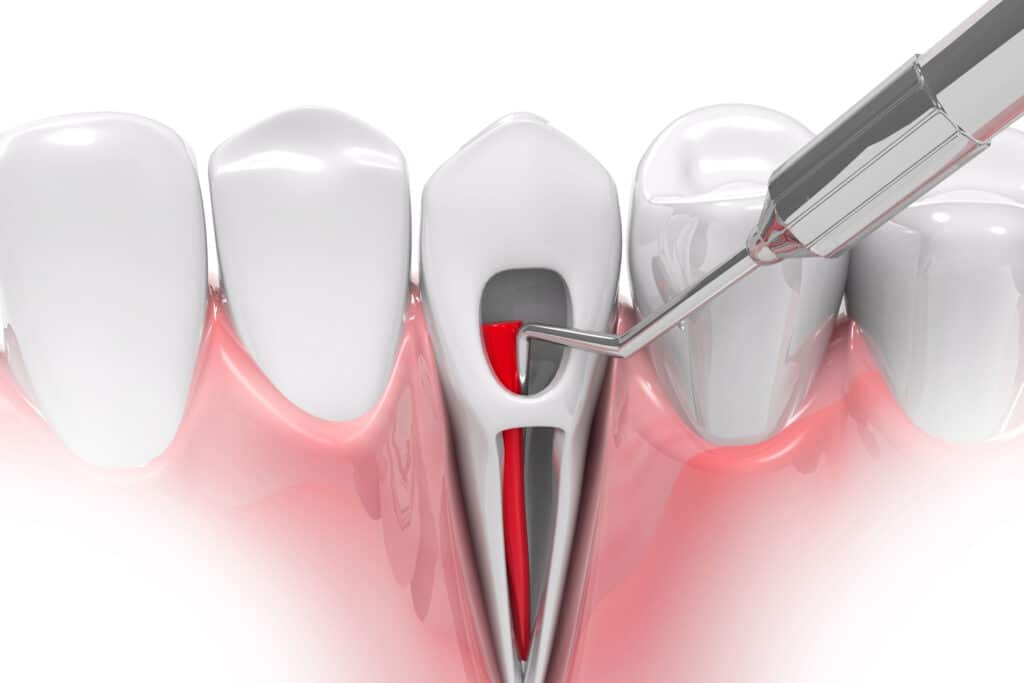 Root canal treatment